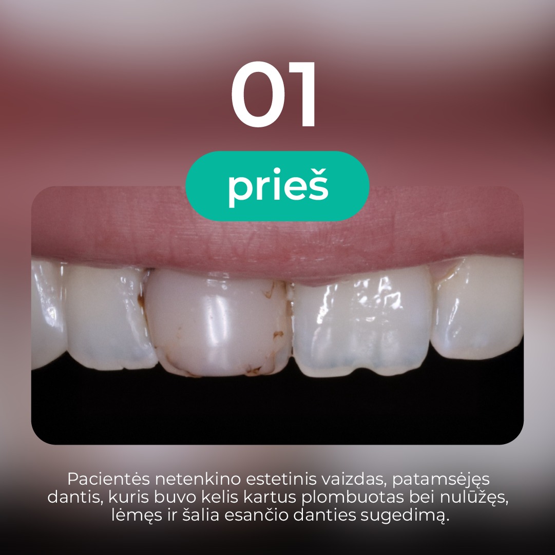 Pajuodęs dantis